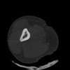 SPORK, NICO - 22.03.1976 - 02.08.2022 - CT obere Extremität - 17:51:17